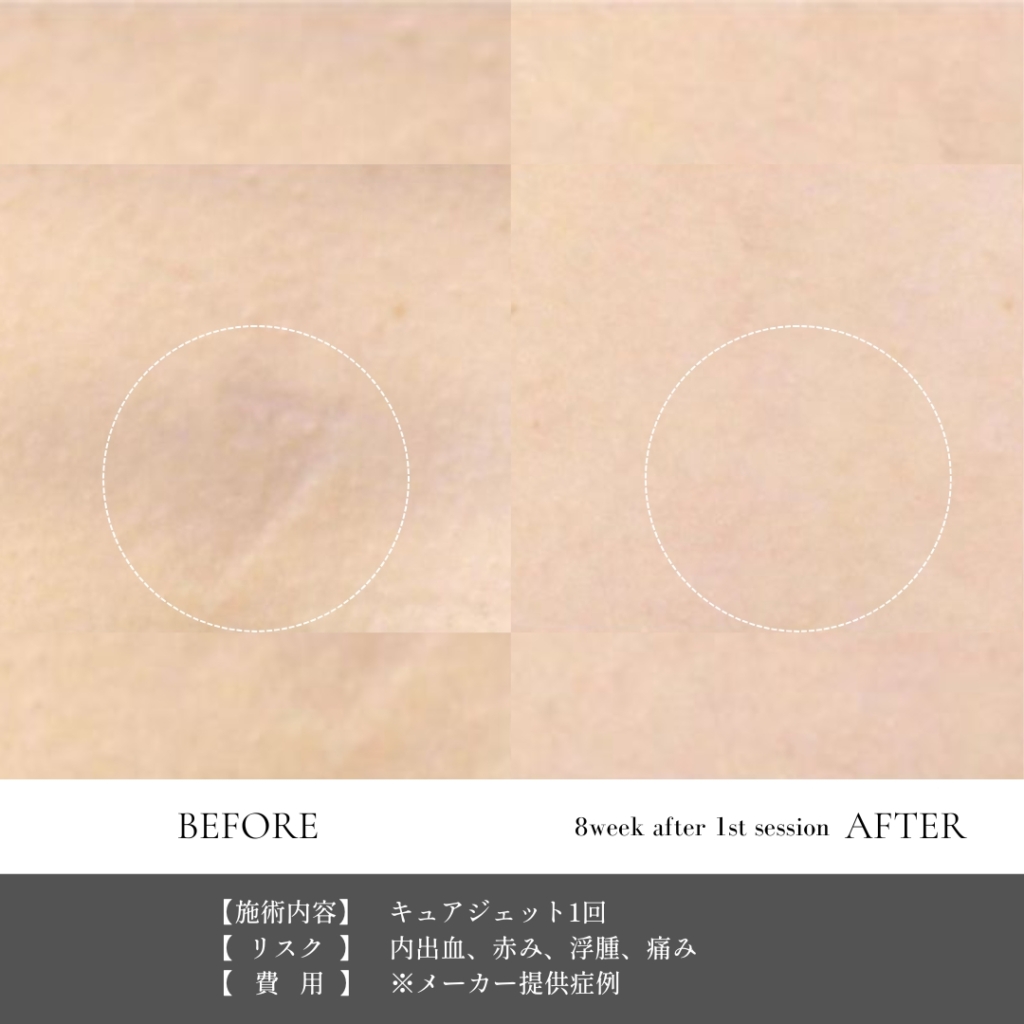 【施術内容】キュアジェット１回
