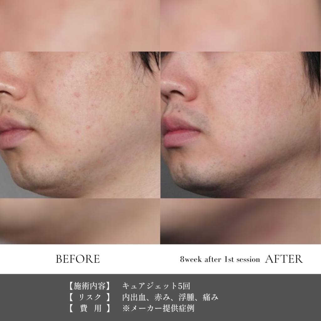 【施術内容】キュアジェット5回
