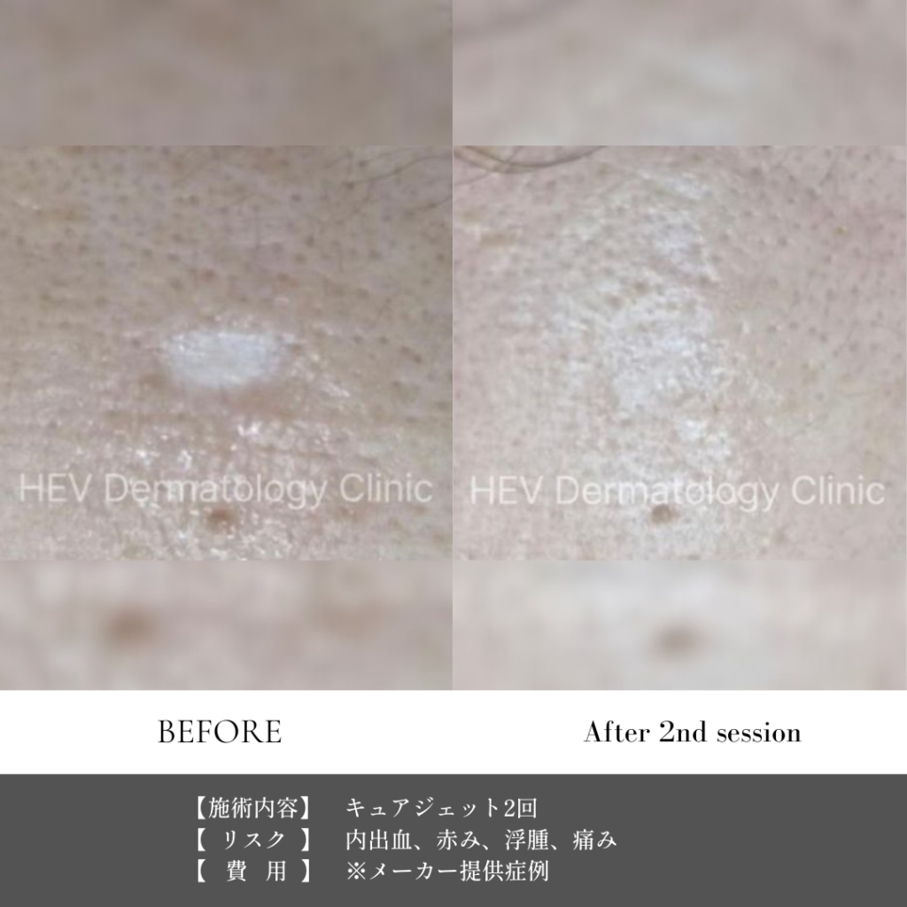 【施術内容】キュアジェット2回