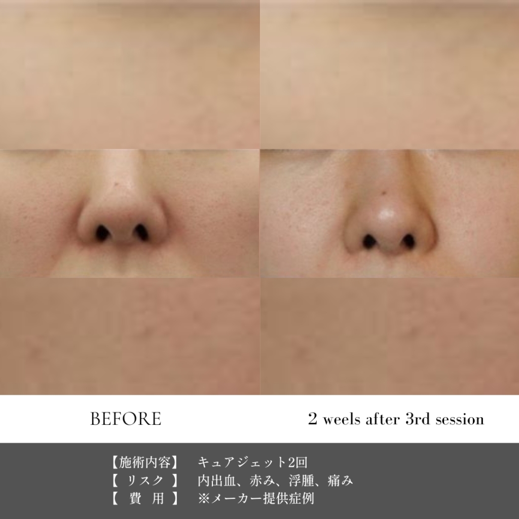 【施術内容】キュアジェット2回