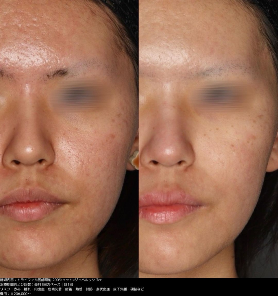 【施術内容】トライフィル医師照射200ショット/ジュベルック3cc1回