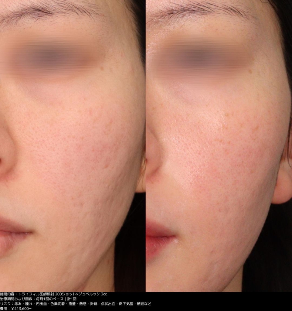 【施術内容】トライフィル医師照射200ショット/ジュベルック3cc1回