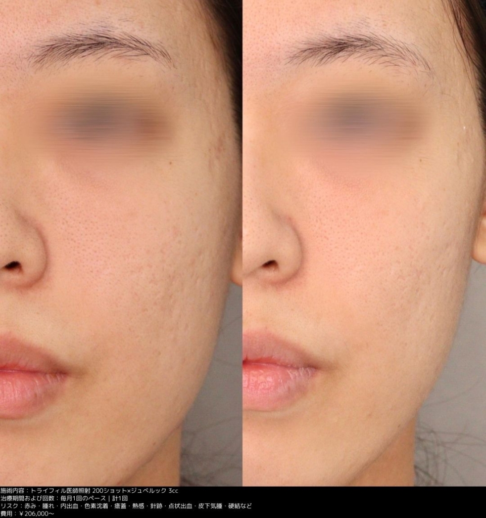 【施術内容】トライフィル医師照射200ショット/ジュベルック3cc1回