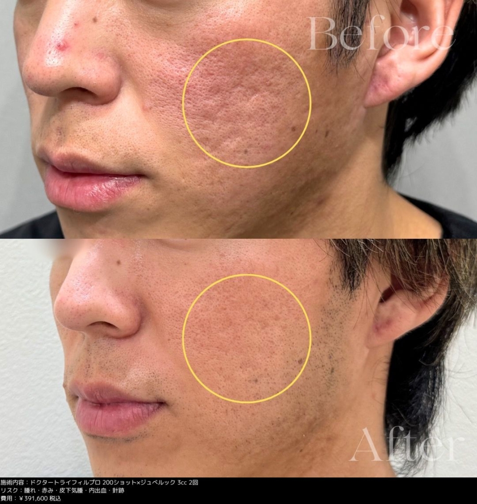 【施術内容】トライフィル医師照射200ショット/ジュベルック3cc2回