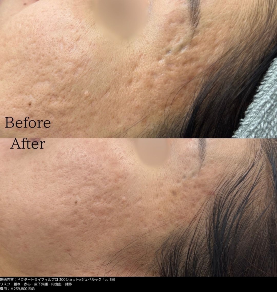 【施術内容】トライフィル医師照射300ショット/ジュベルック4cc1回