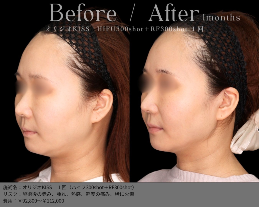 【施術内容】オリジオKISS（キス）1回