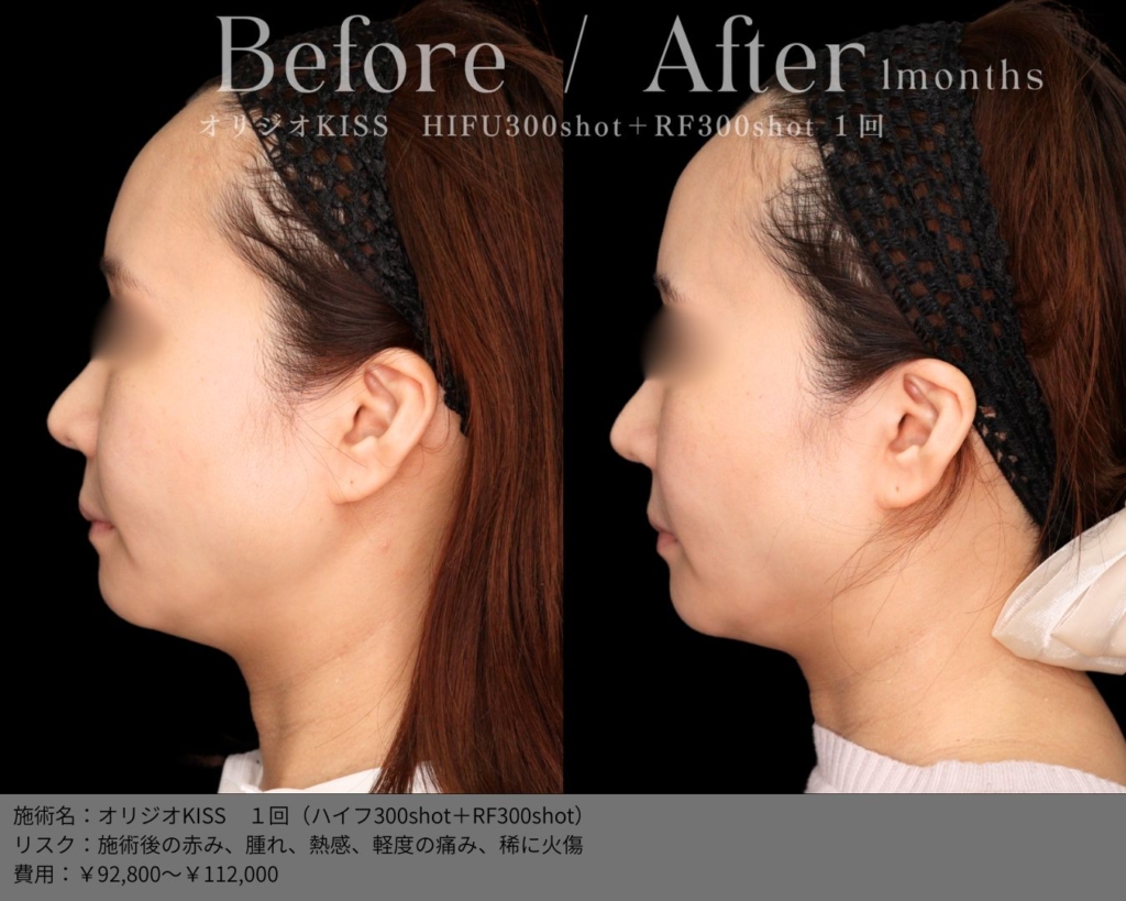 【施術内容】オリジオKISS（キス）1回