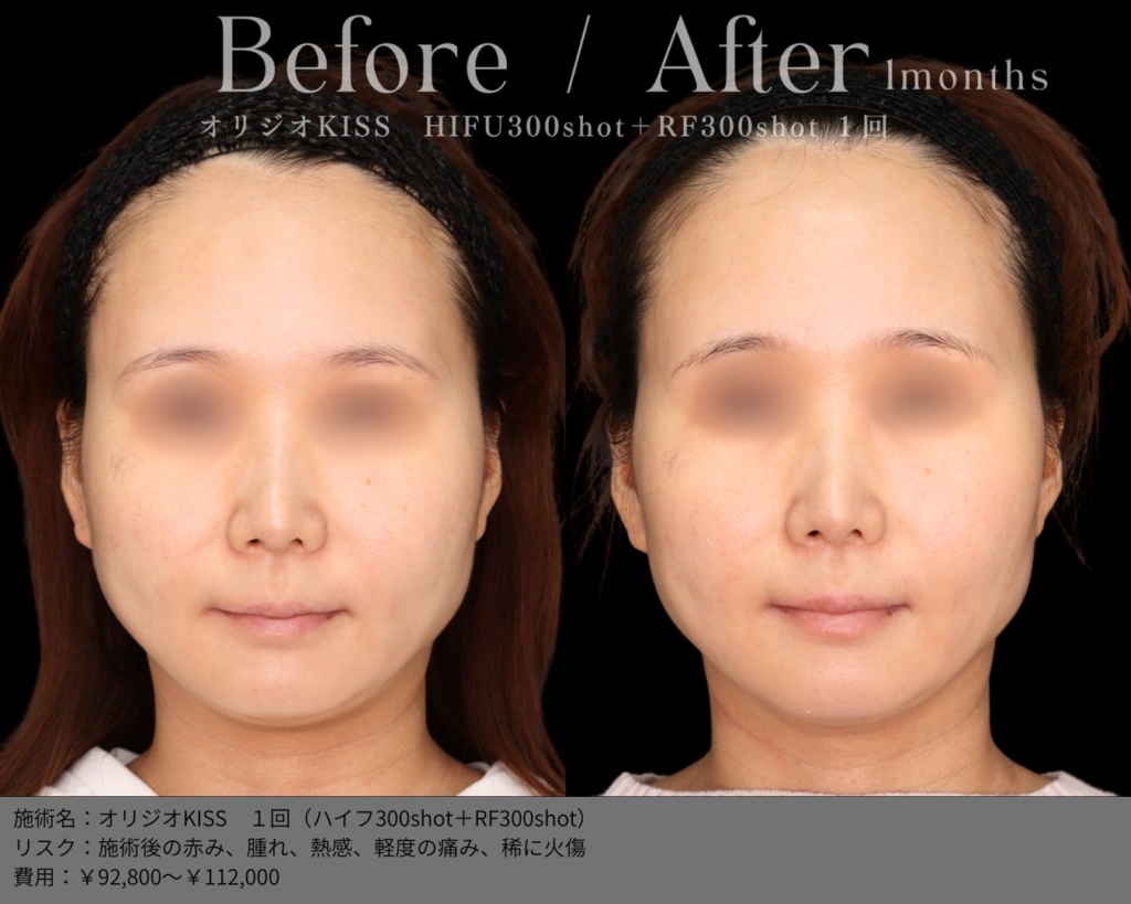 【施術内容】オリジオKISS（キス）1回