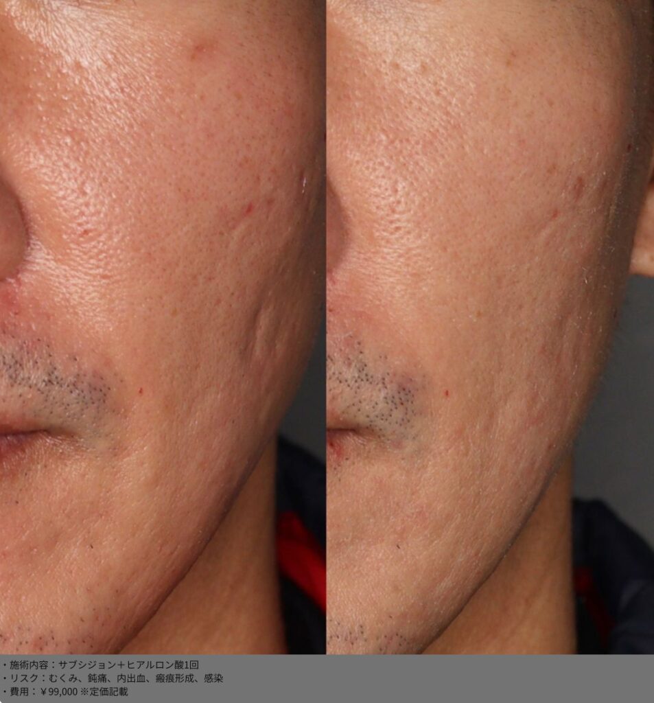 【施術内容】サブシジョン＋ヒアルロン酸1回