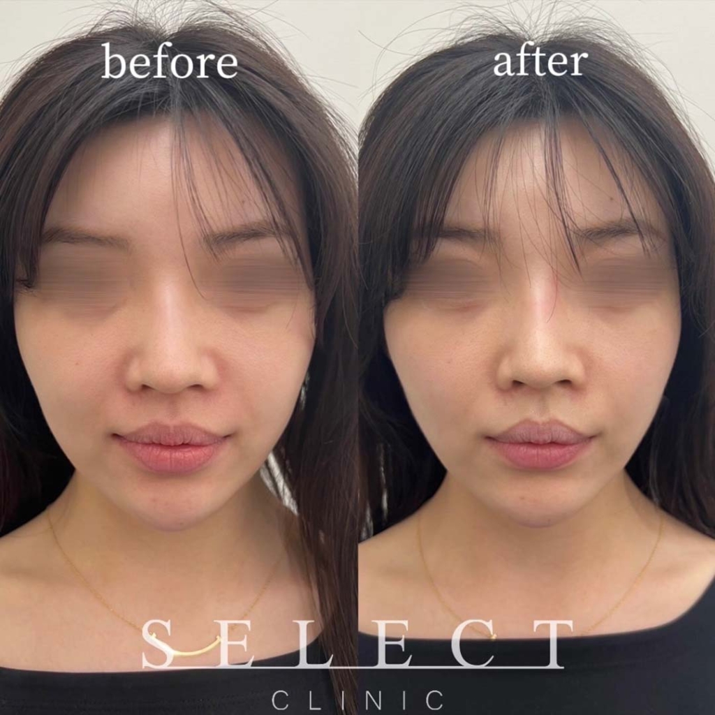 【施術内容】インモードVリフト（FORMA＋ミニFX）1回