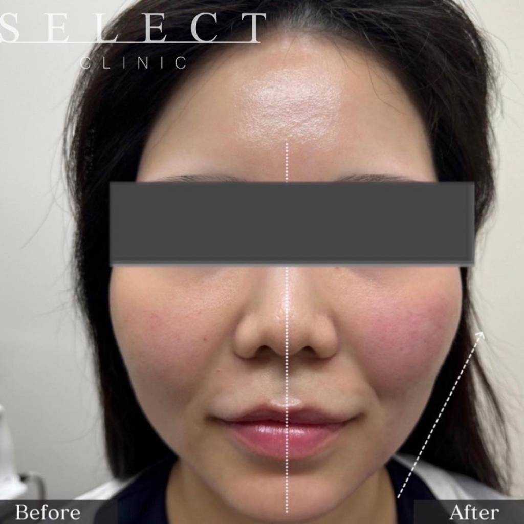 【施術内容】インモードVリフト（FORMA＋ミニFX）2回