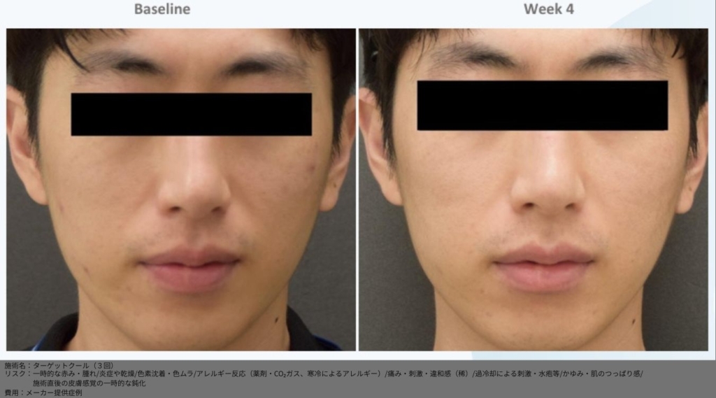 【施術内容】ターゲットクール3回