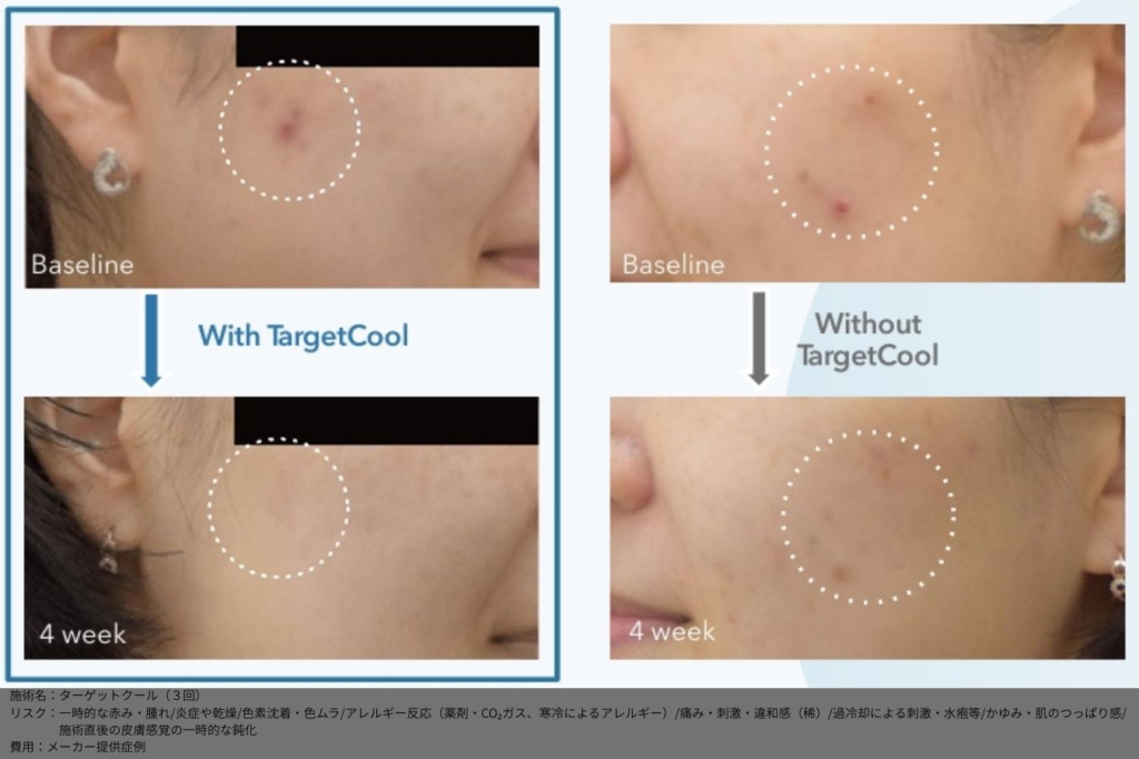 【施術内容】ターゲットクール3回