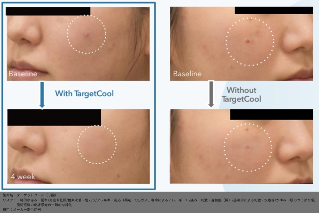 【施術内容】ターゲットクール3回