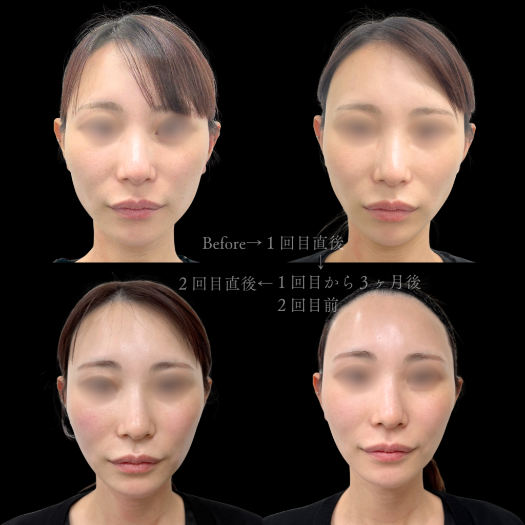 【施術内容】オンダリフト（両頬＋顎下）２回