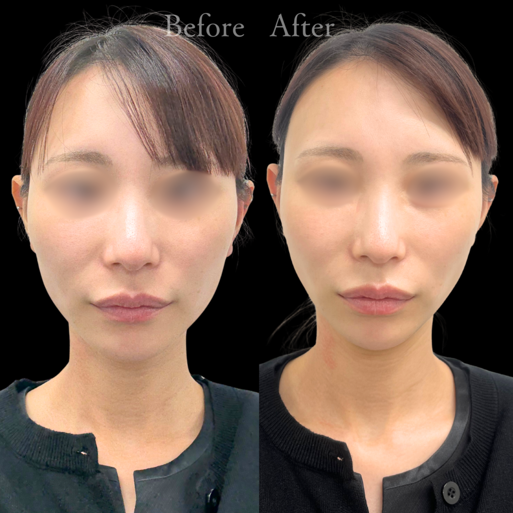 【施術内容】オンダリフト（両頬＋顎下）１回