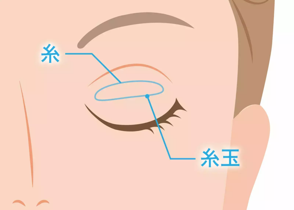二重埋没法