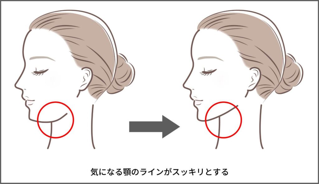 ペリカンリフト