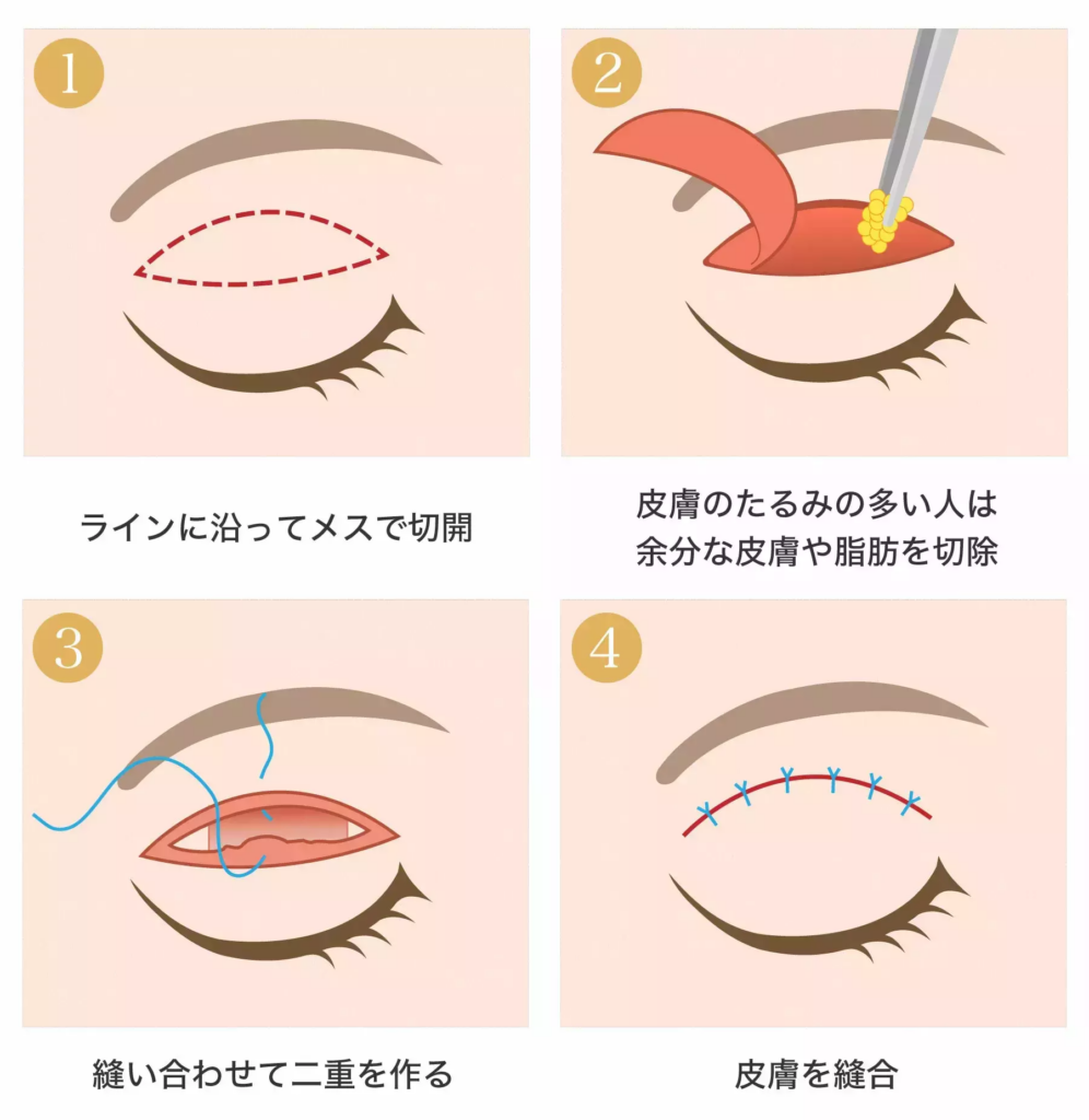 二重全切開法