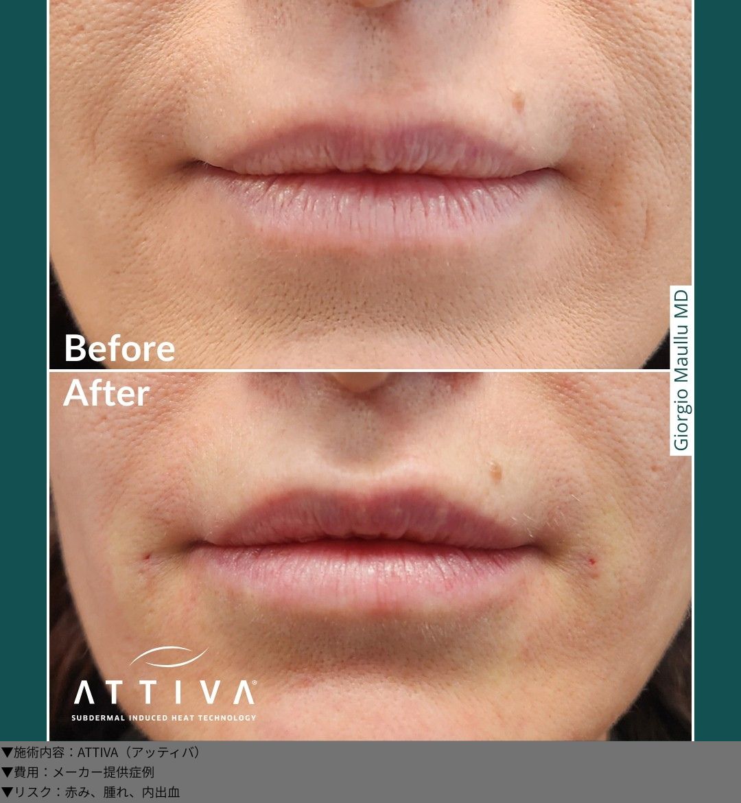ATTIVA(アッティバ)