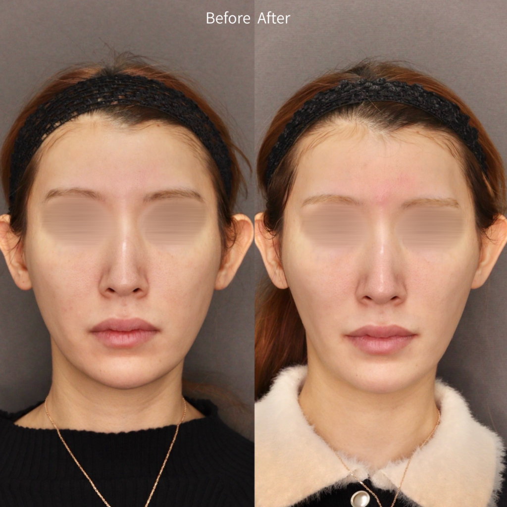 【施術内容】セレクトリフト10本×ジャルプロスーパーハイドロ