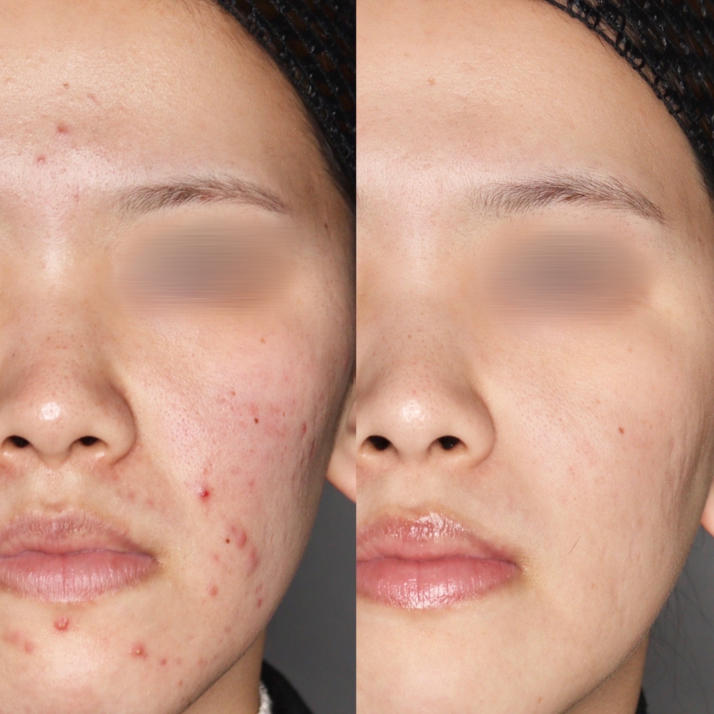 【施術内容】ピコレーザートーニング20回×ミックスピーリング9回×ピコフラクショナル（鼻＋頬）3回×イソトロイン8ヶ月内服