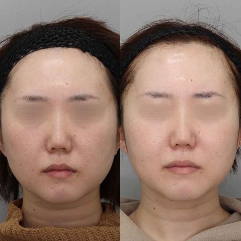 【施術内容】ピコフラクショナル5回×ミックスピーリング4回