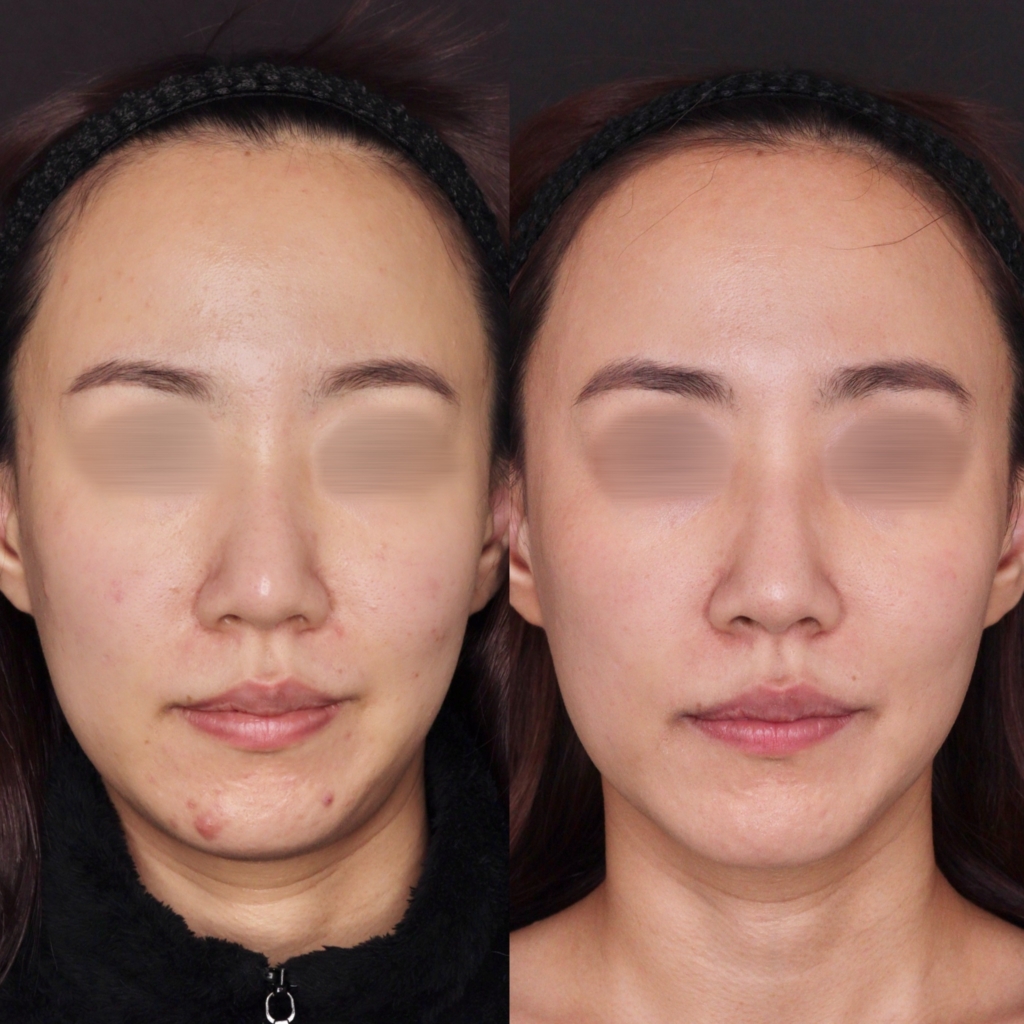 【施術内容】ポテンツァマックーム１回×ピコダブル8回×ミックスピーリング5回×ケアシス（ペップビュー）1回