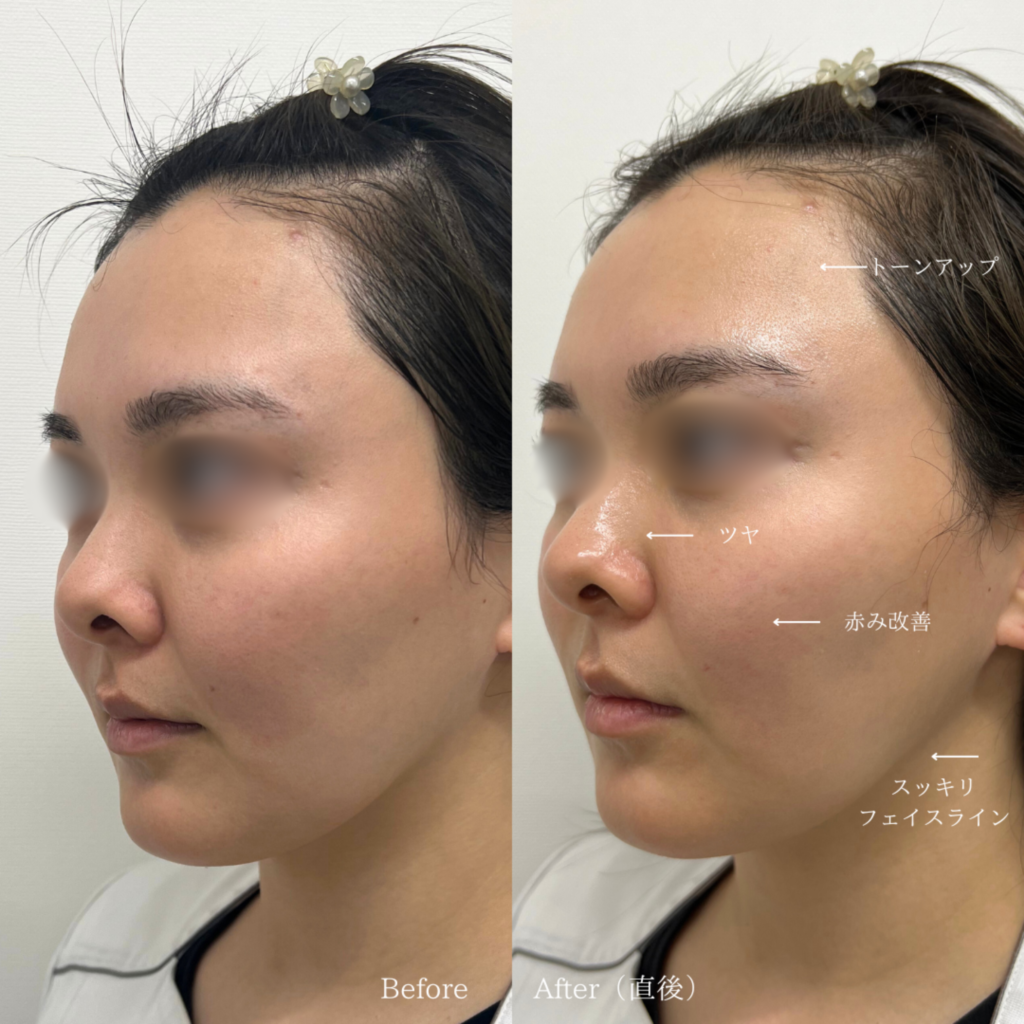 【施術内容】ララドクター1回