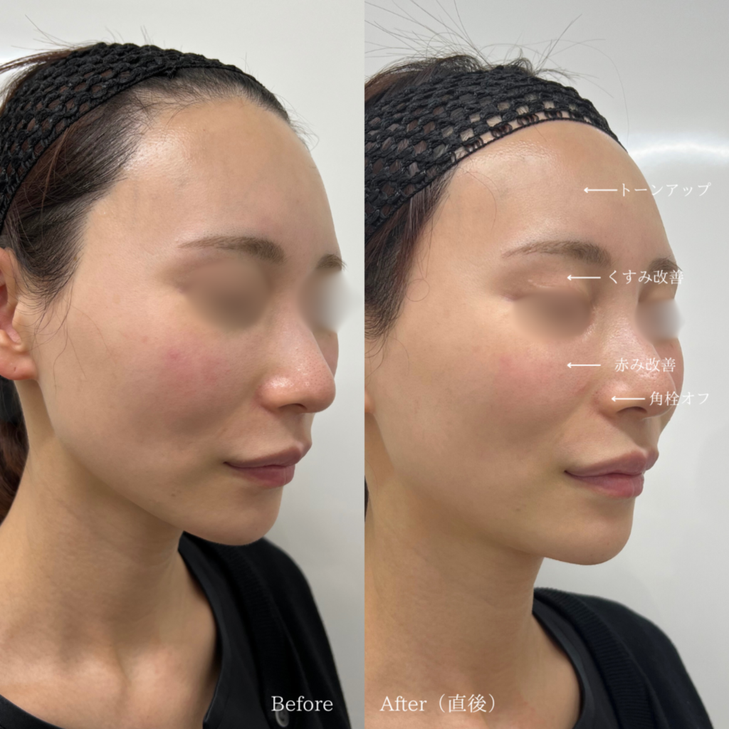 【施術内容】ララドクター1回