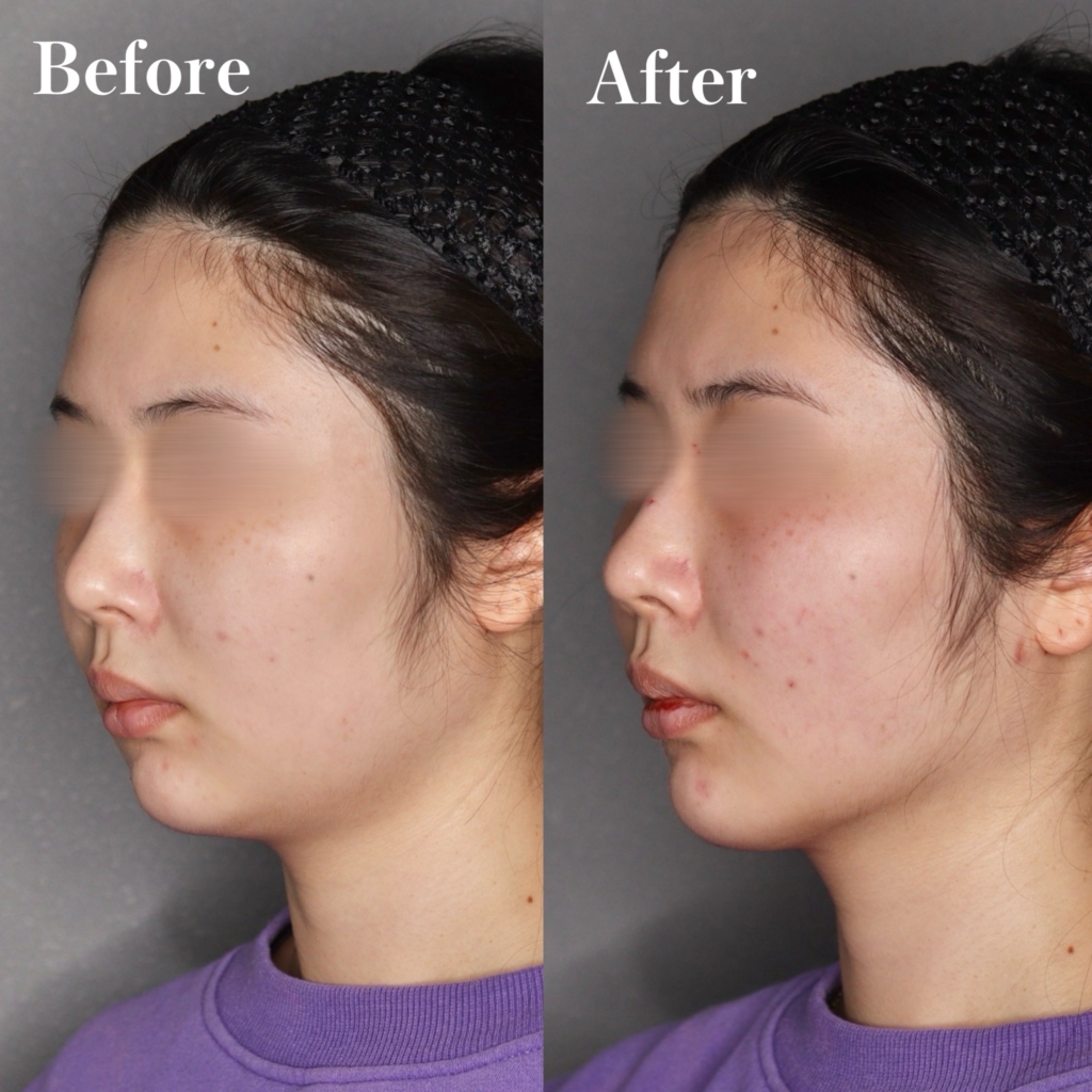 脂肪吸引（頬+顎下）、セレクトリフト10本