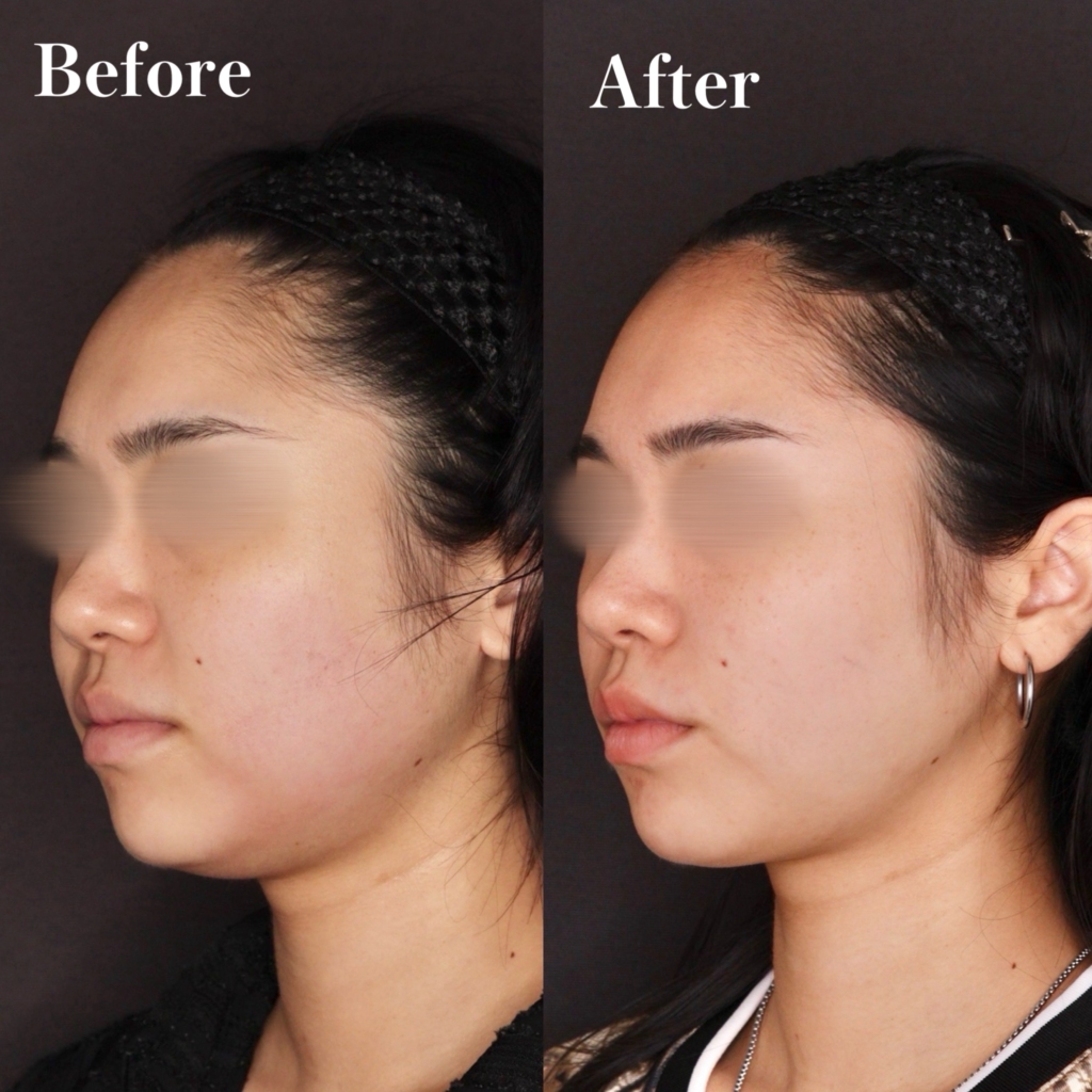 脂肪吸引(頬+顎下）、﻿セレクトリフト10本