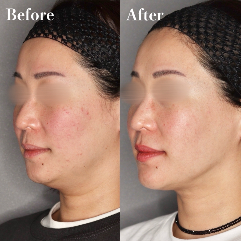 脂肪吸引(頬+顎下)、セレクトリフト10本、ヒアルロン酸(顎)ボラックス1cc