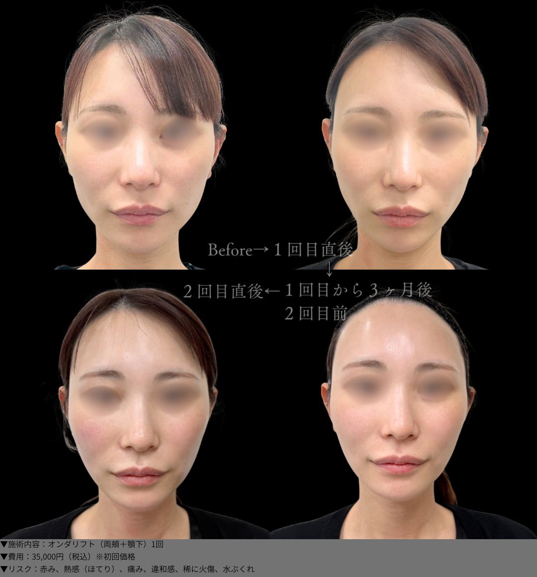 オンダリフト