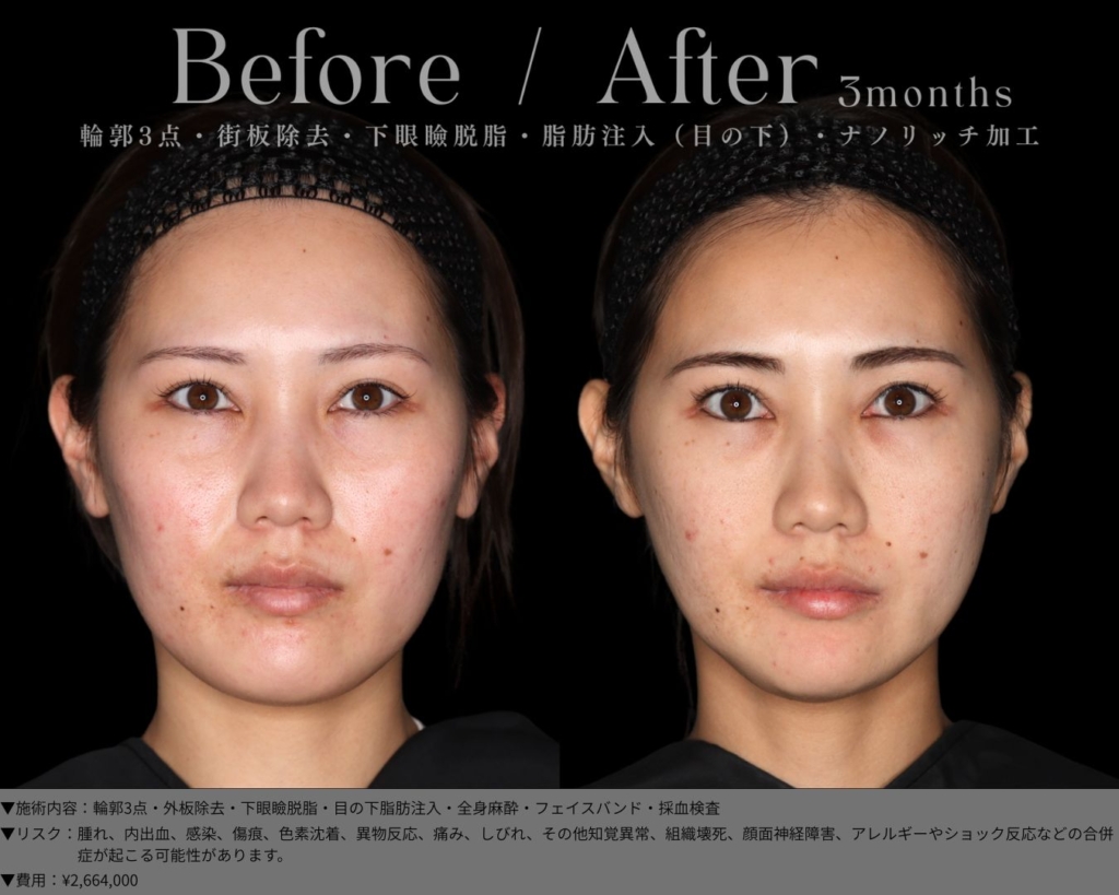 【施術内容】輪郭3点＋外板除去＋下眼瞼脱脂＋目の下脂肪注入