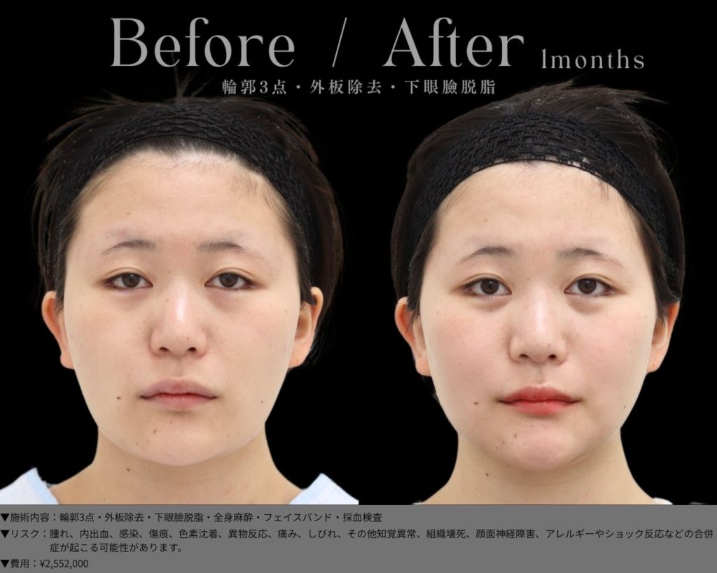 【施術内容】輪郭3点＋外板除去＋目の下のクマ取り