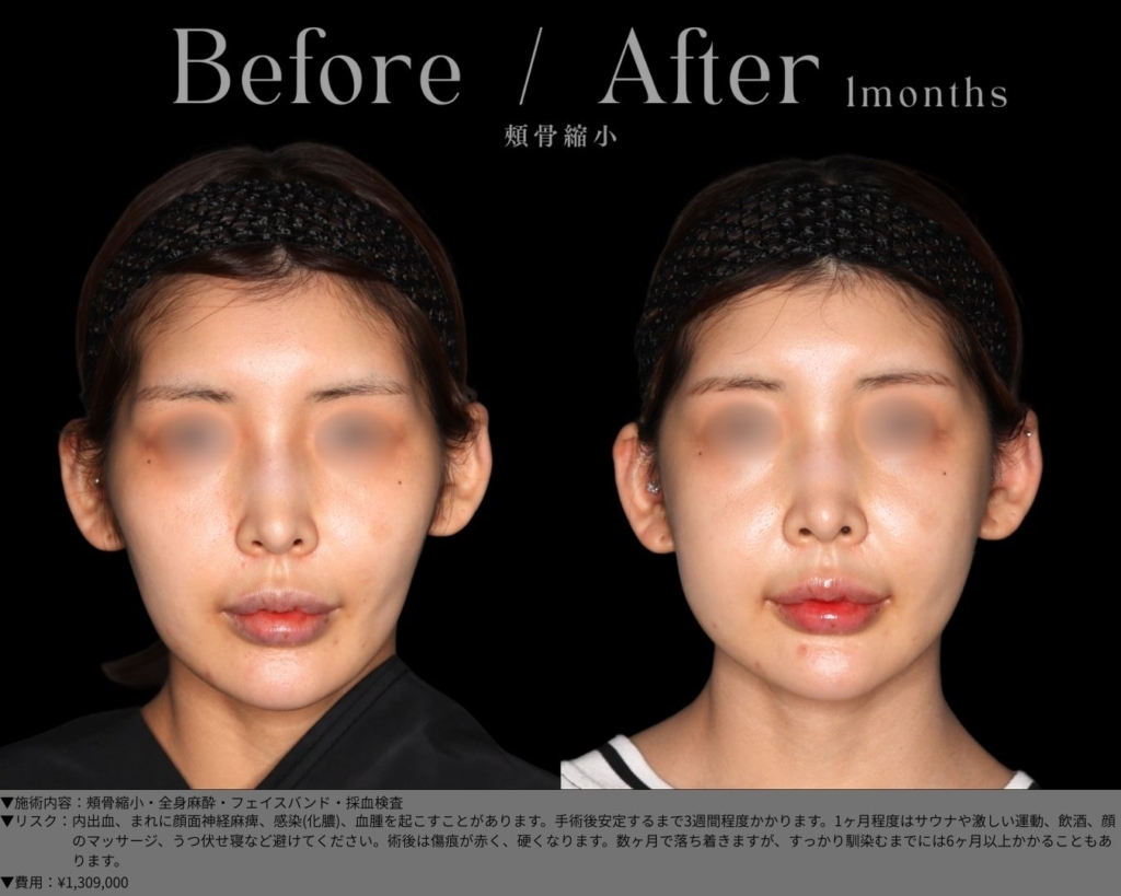 【施術内容】頬骨縮小