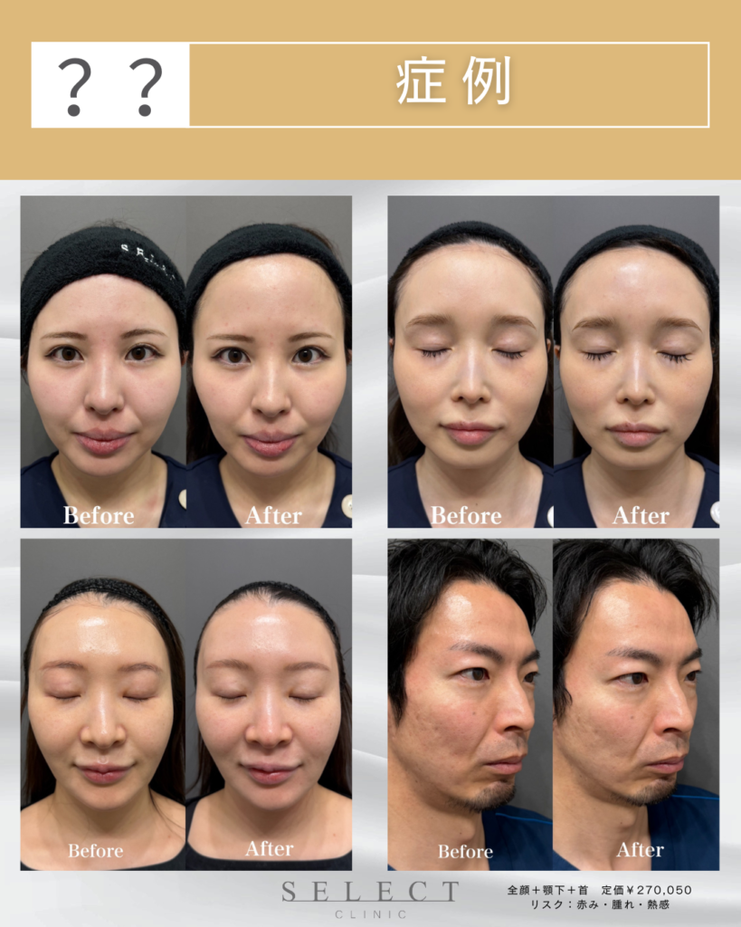 ソフウェーブ 症例 ビフォーアフター