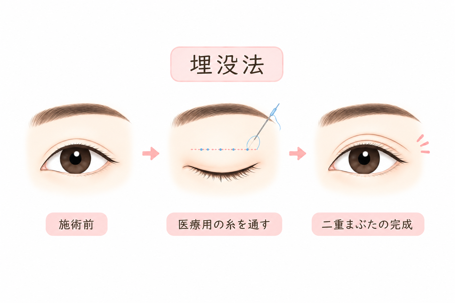 埋没法　とは