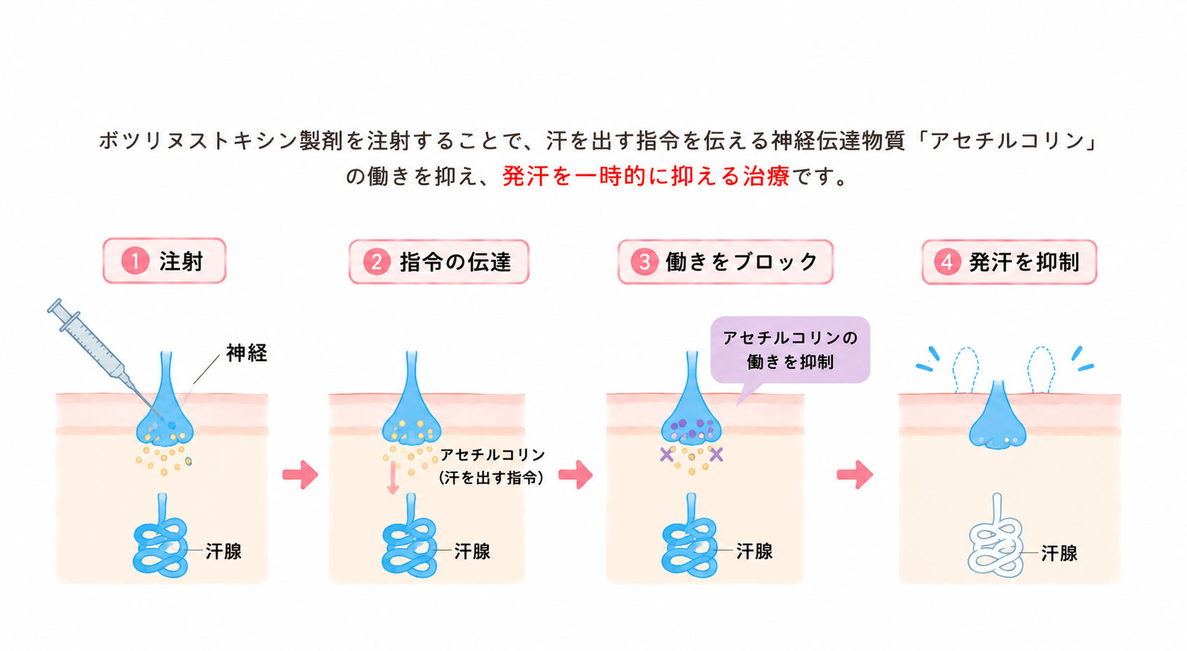 汗止めボトックス　仕組み