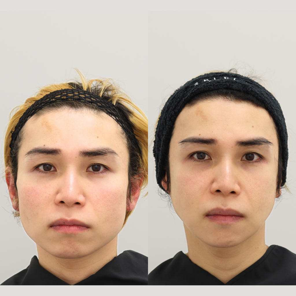 輪郭3点＋頬骨セットバック＋外板除去＋咬筋切除