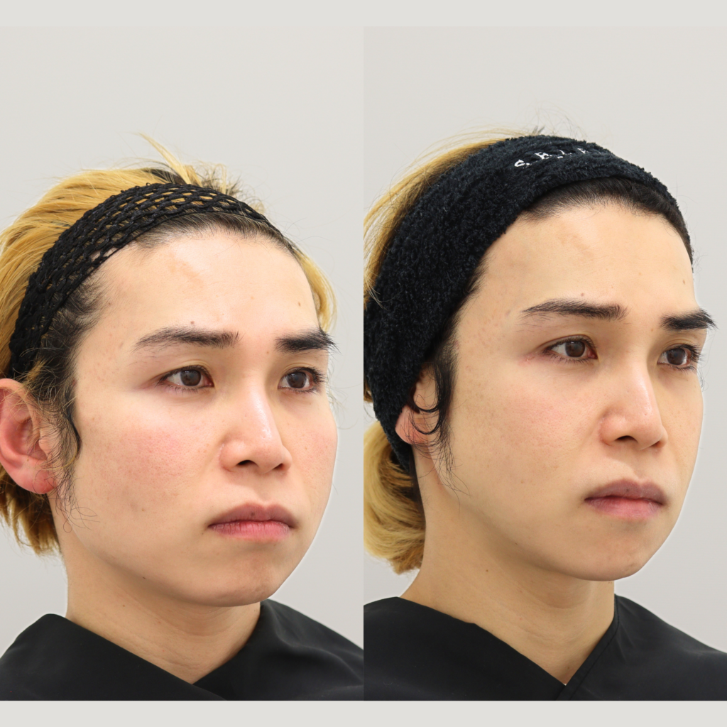 輪郭3点＋頬骨セットバック＋外板除去＋咬筋切除