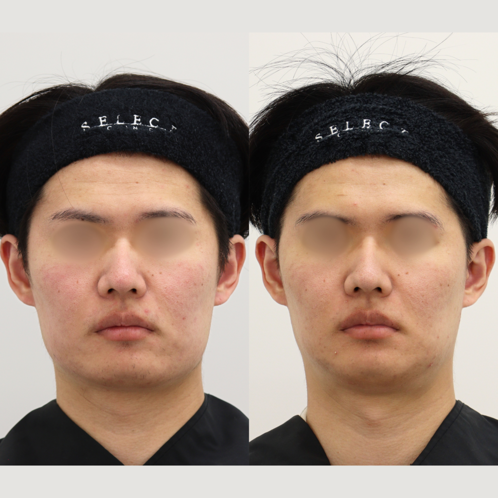 Vライン形成＋外板除去