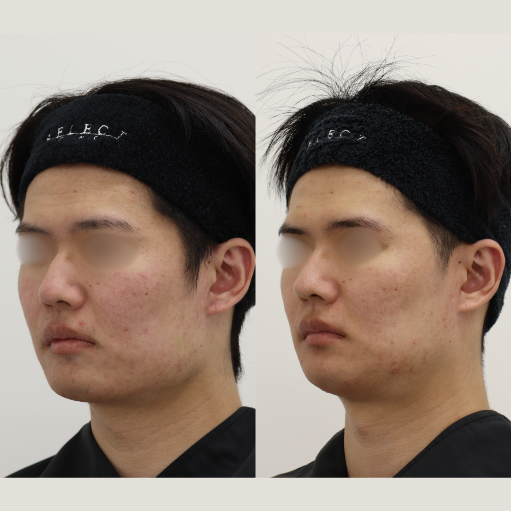 Vライン形成＋外板除去