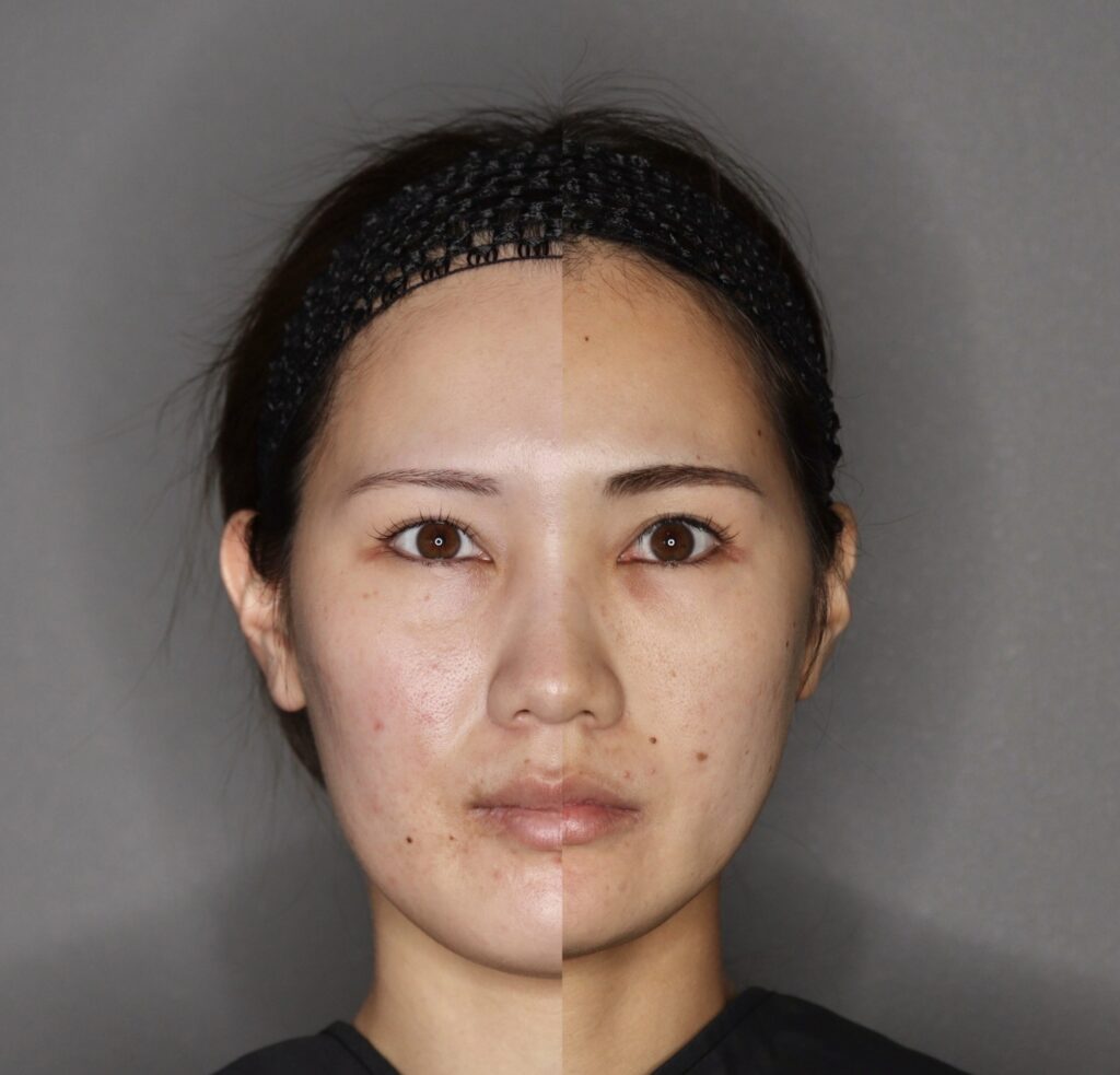 輪郭3点＋外板除去、目の下クマ取り、脂肪注入(目の下)＋ナノリッチ加工、ボトックス注射(エラ)