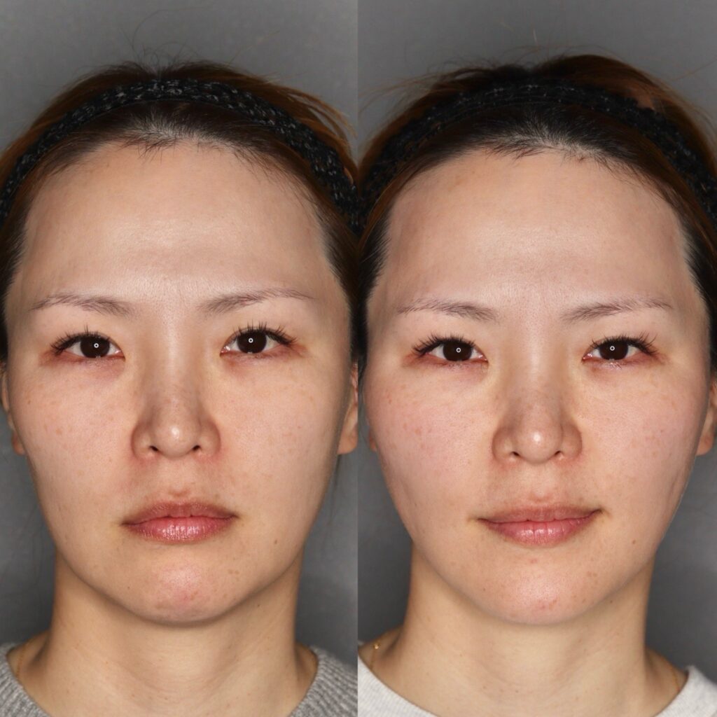 セレクトリフト