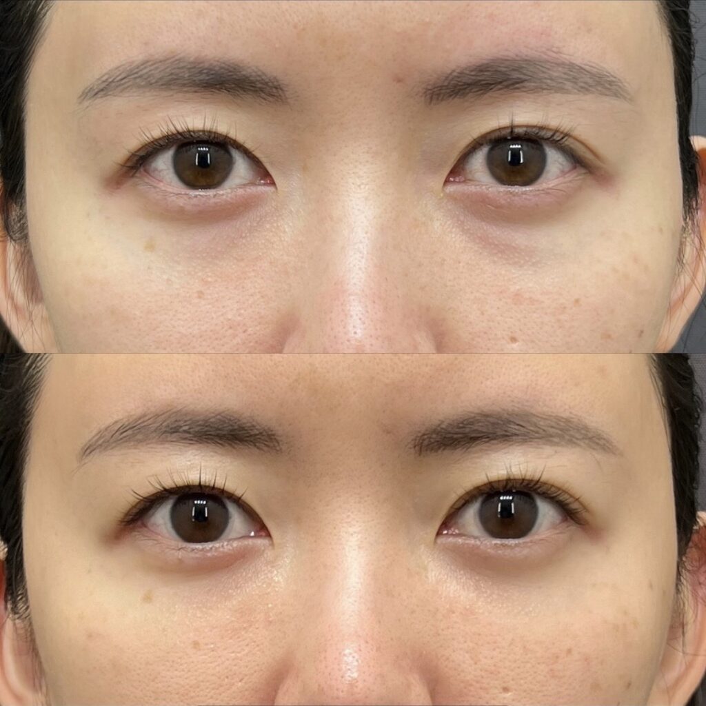 目の下クマ取り、目の下脂肪注入
