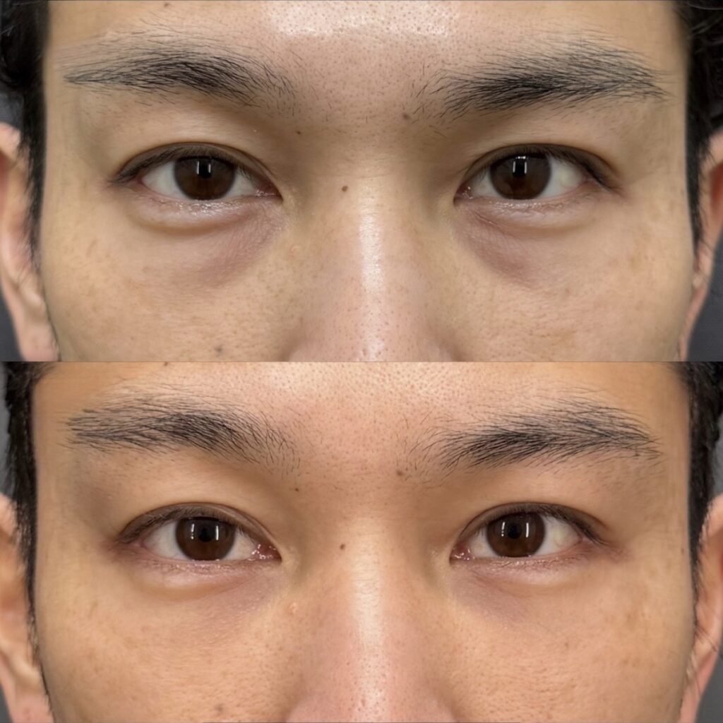 目の下クマ取り、目の下脂肪注入