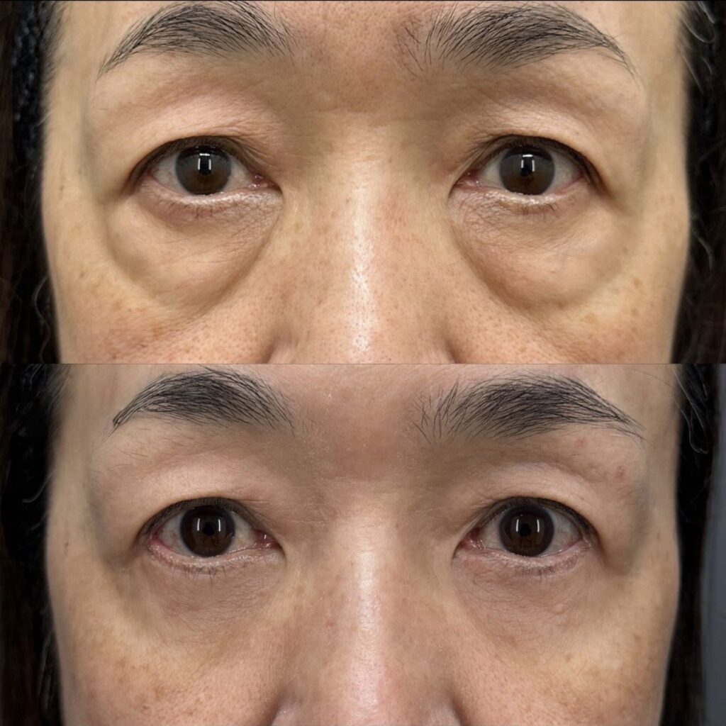 表ハムラ