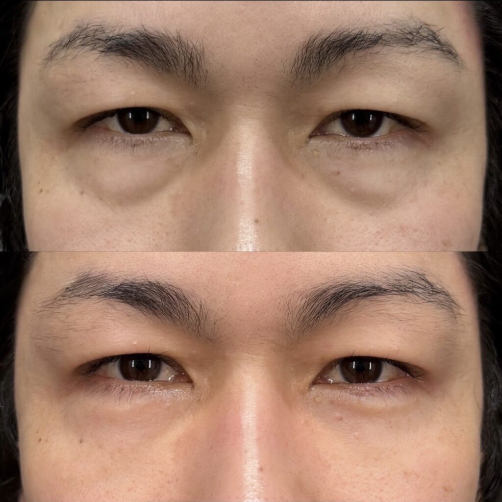 裏ハムラ